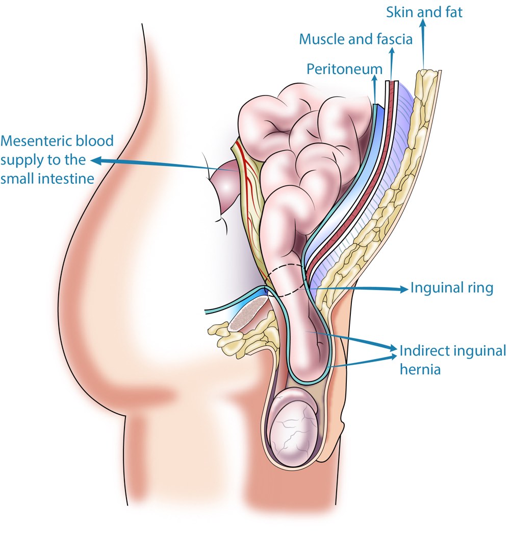 direct and indirect inguinal hernia