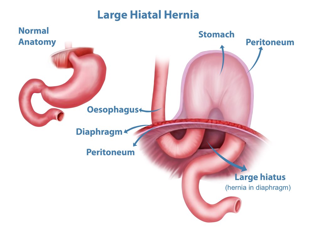 Inguinal Hernia Perth, Hernia Repair Surgery