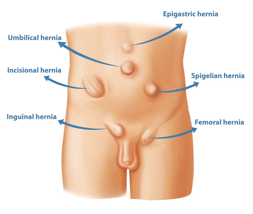 Types of Hernia, Hernia Surgery & Hernia Repair